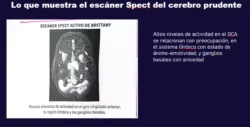 Cerebro prudente: se prepara bien, pero tiene demasiados miedos – Neuroanatomía con agua bendita (V) 4 8 2 1